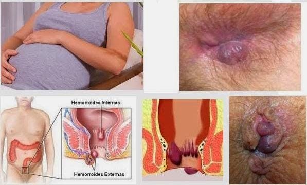 Foto obat wasir untuk ibu hamil di apotik