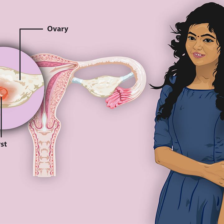 PCOS and PCOD: Causes, Symptoms, & Treatment