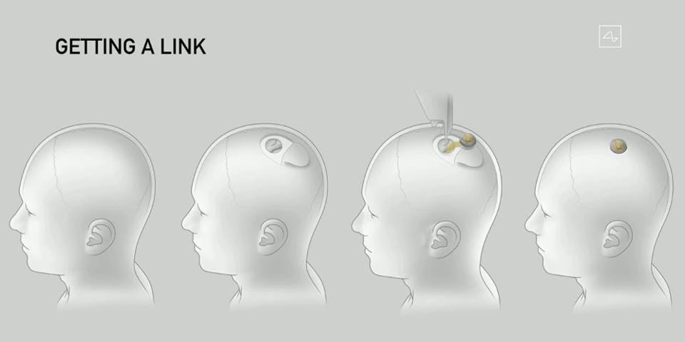 Neuralink è un chip che viene installato direttamente nel cranio