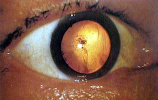 Photograph of a victim’s eyeball after bombing of Hiroshima with an ‘atomic bomb’ cataract, 1945.