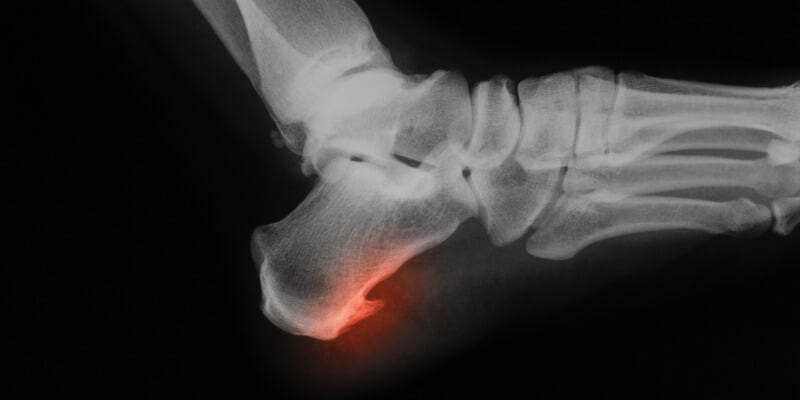 How to Dissolve Bone Spurs Naturally - Centeno-Schultz Clinic