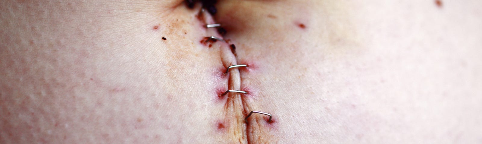 Post surgery stapled tummy scar