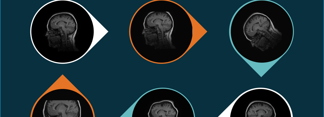 Image augmentation: how to overcome small radiology datasets