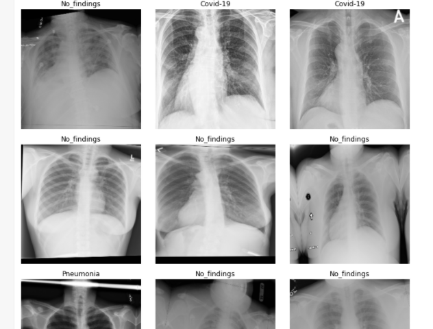 Chest X Ray – Analytics Vidhya – Medium