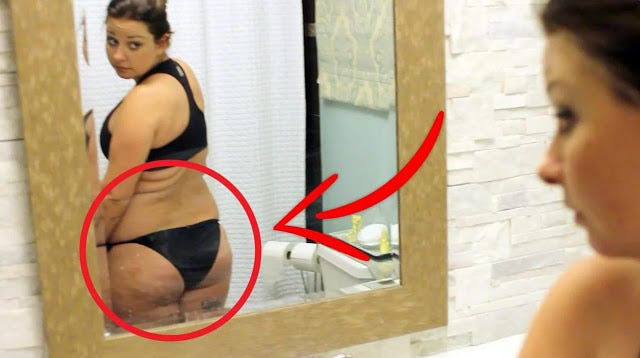 Weight loss without surgery