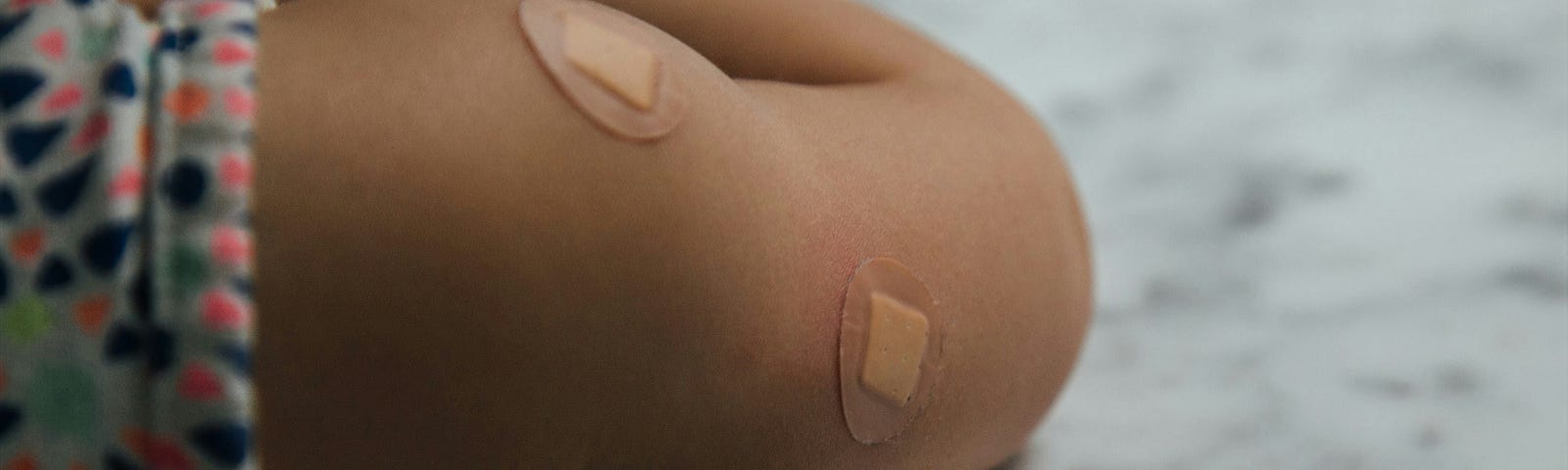 A picture of an arm with bandages on it.