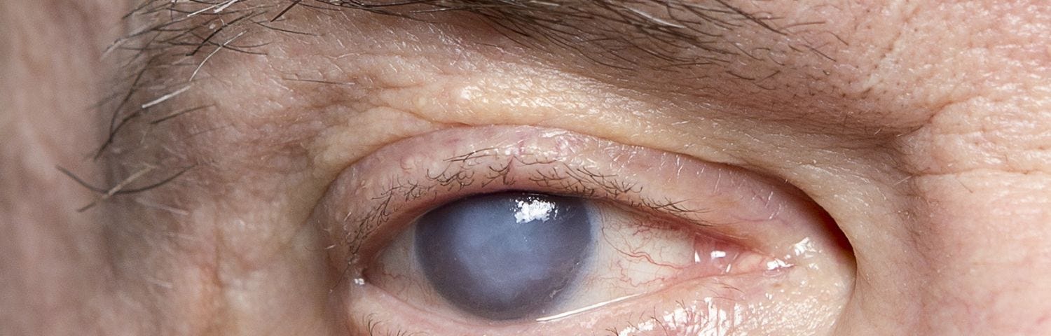 Cataract affected eye