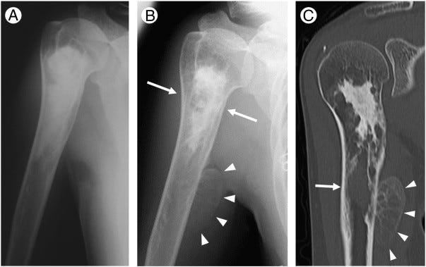 X-rays showing a lesion on a bone.