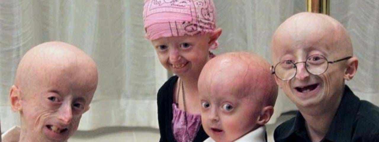 Progeria Disorder