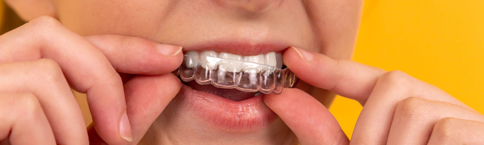 A woman inserting an Invisalign retainer
