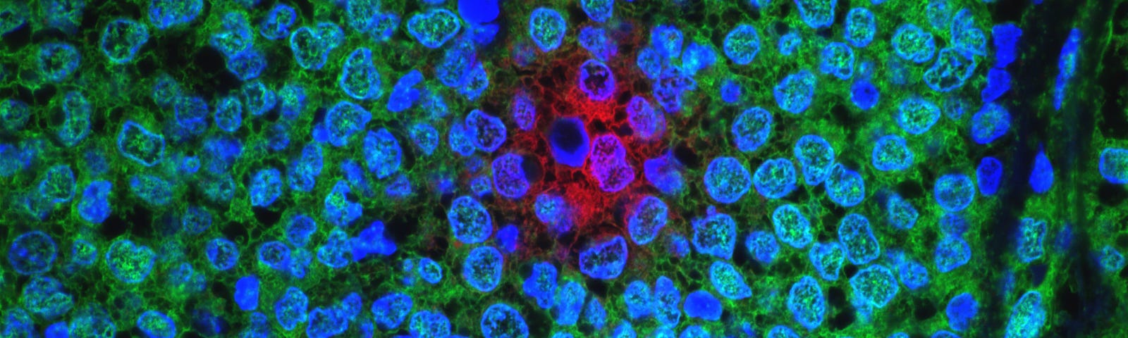 Breast cancer cells image by NIH for James Goydos MD, 2020 blog article — ‘what you may not know about breast cancer’.