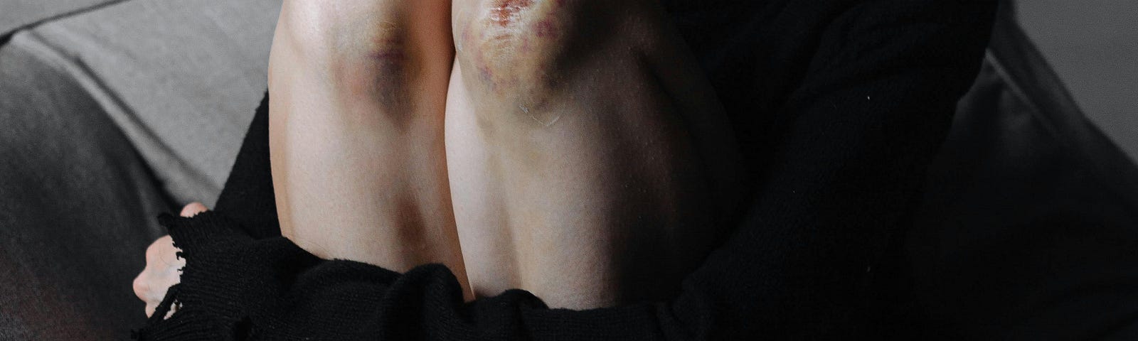Young Woman with Bruises on Her Legs Sitting on a Sofa
