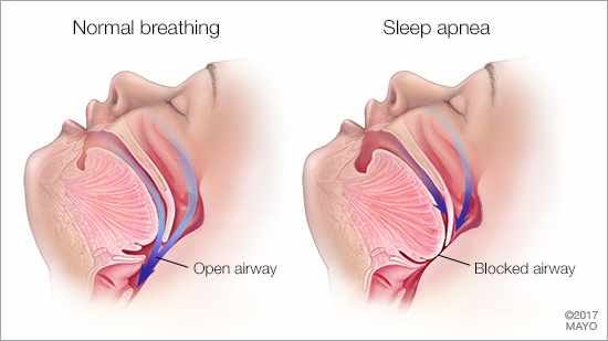 Apa itu sleep apnea