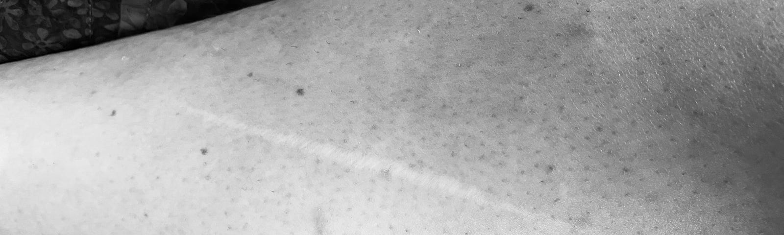 black and white photo of a pale, thin, straight line scar on a person’s calf.