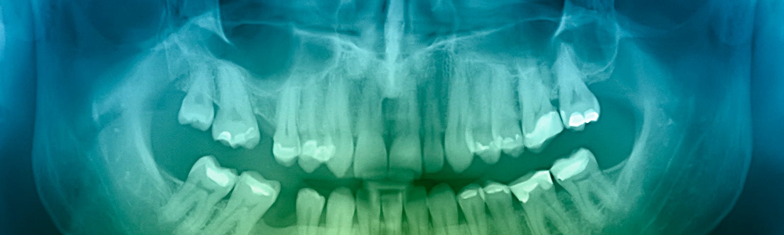 An X-ray of a patient’s mouth/teeth/jaw. It appears to be smiling.