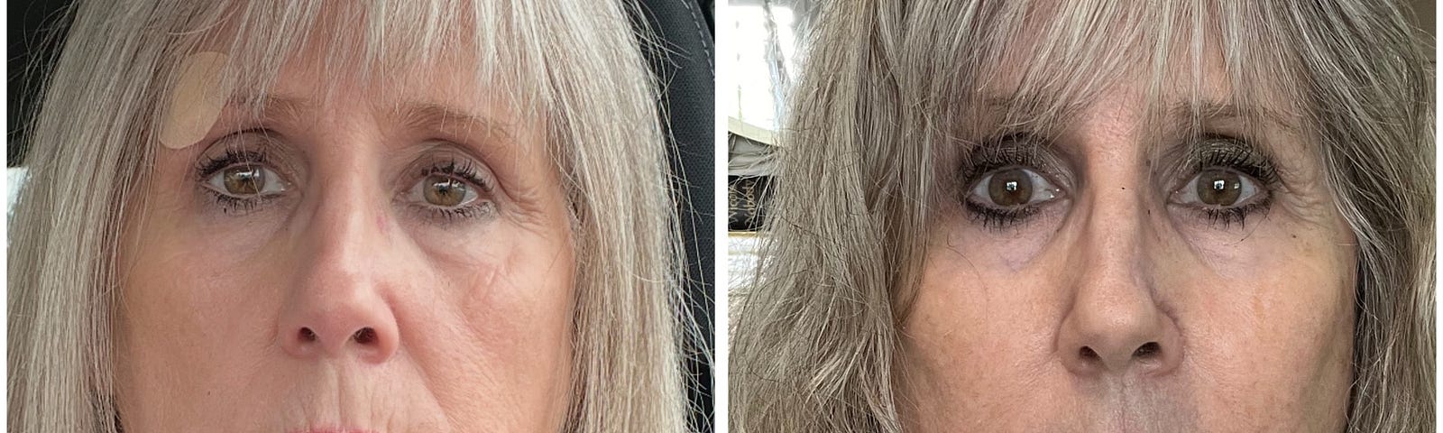 A side by side comparison of the author before her facelift and now three weeks later looking younger and feeling more confident.