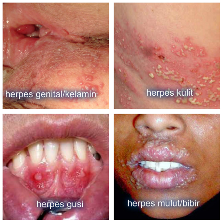 Cara Mengobati Penyakit Herpes Dengan. 