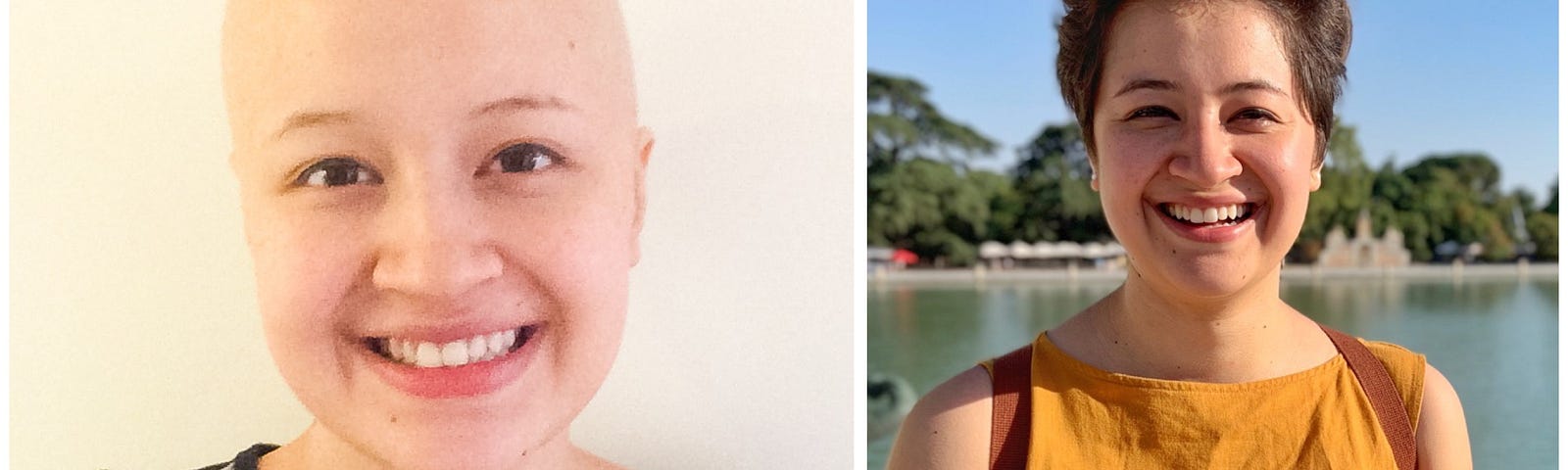 Picture on the left shows a bald person with a scar on the chest. Picture on the right shows same person with short hair.