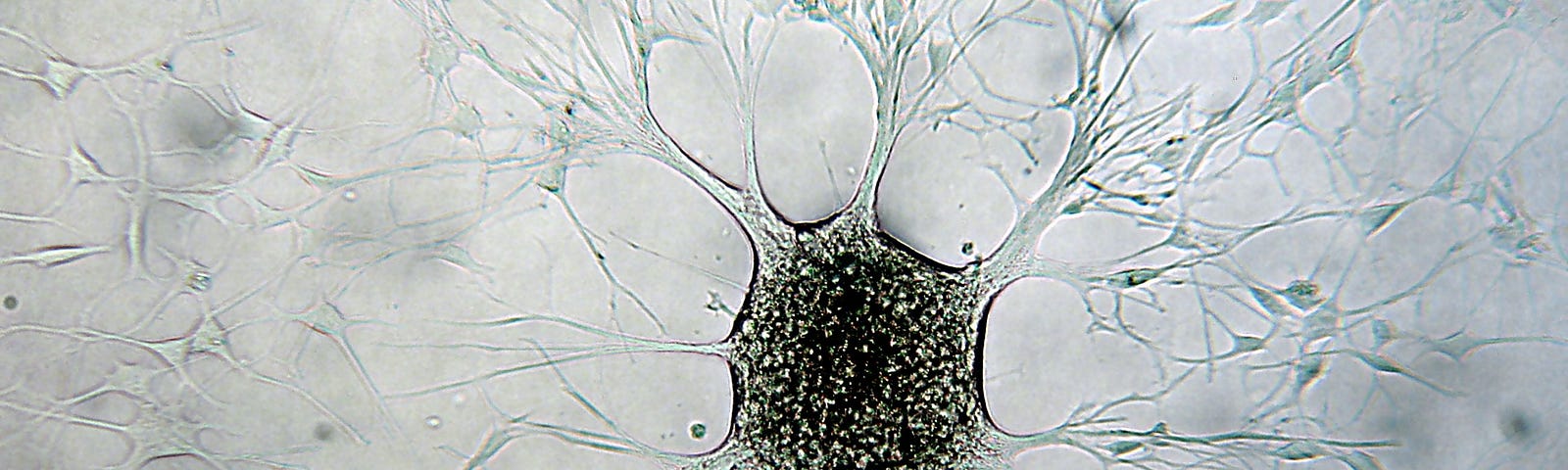 Glioblastome multiforme. Image credit: Notarangelo Angelantonio