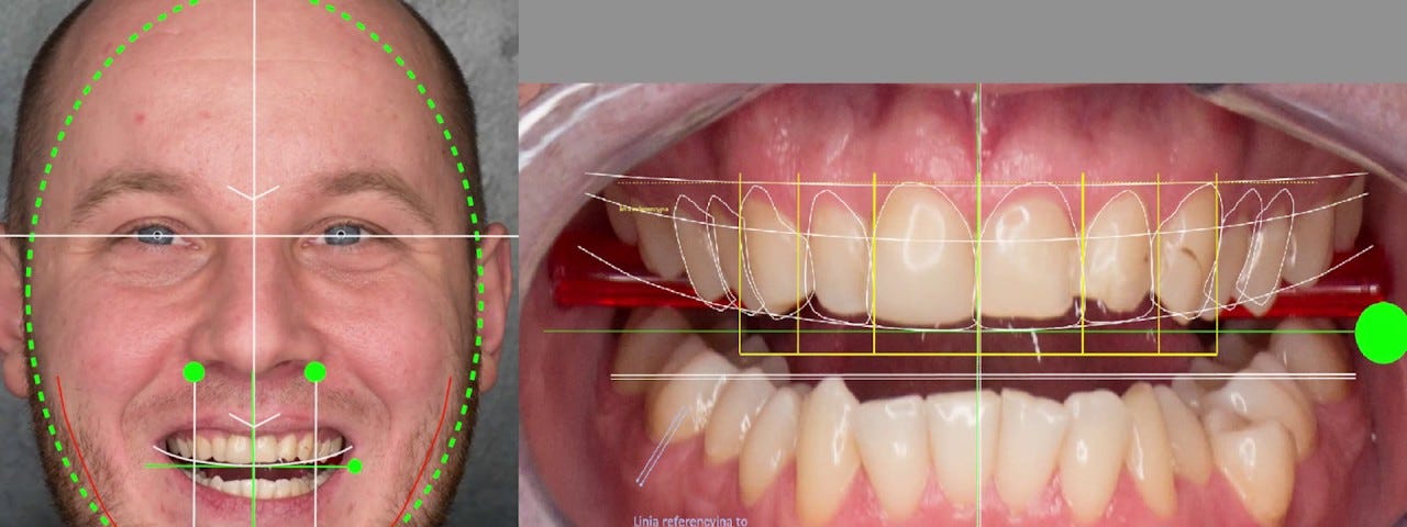 Thẩm mỹ nụ cười — Giúp lấy lại nụ cười rạng rỡ cho bạn