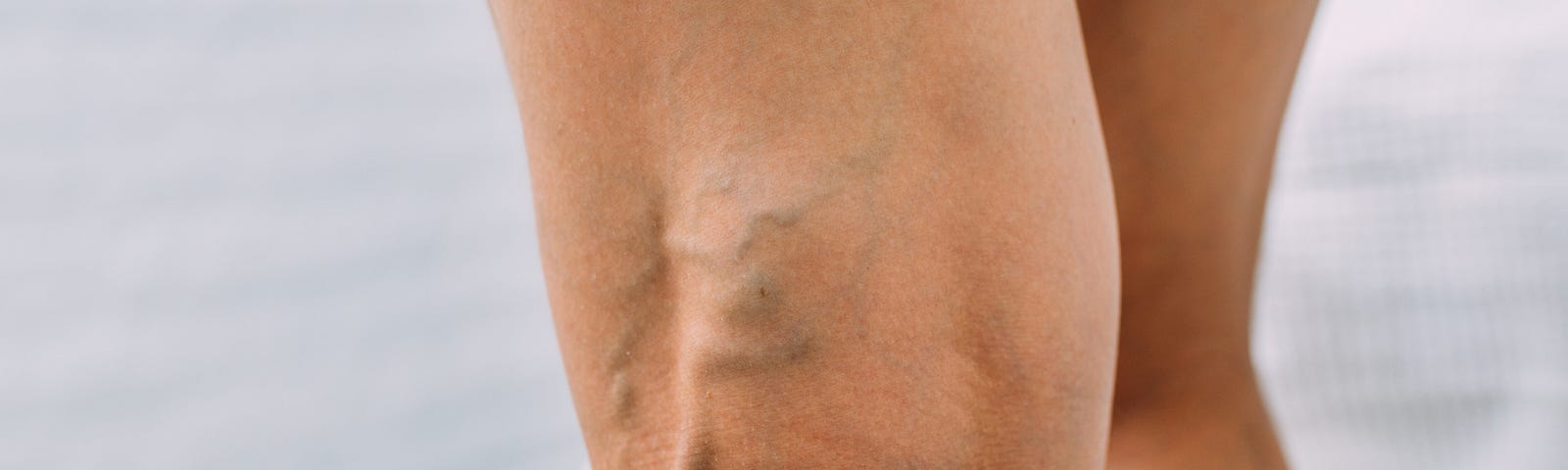 Enlarged veins on the back of the knee.