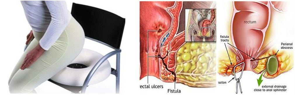 Anal Fistula And Kshar Sutra Treatment