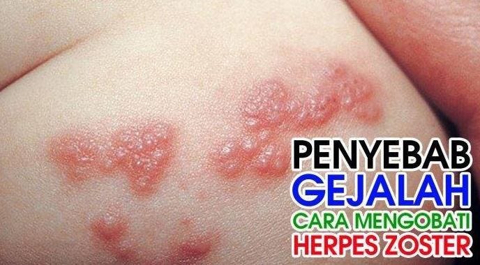 cara mengatasi penyakit herpes biar cepat sembuh.