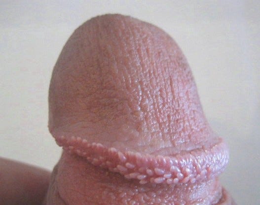 Papules pearly penile Pearly Penile