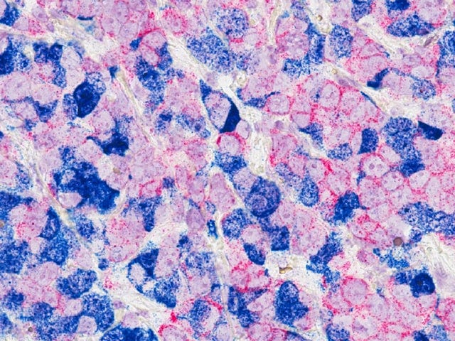 Close up image of breast cancer cells dyed pink and blue for visibility.