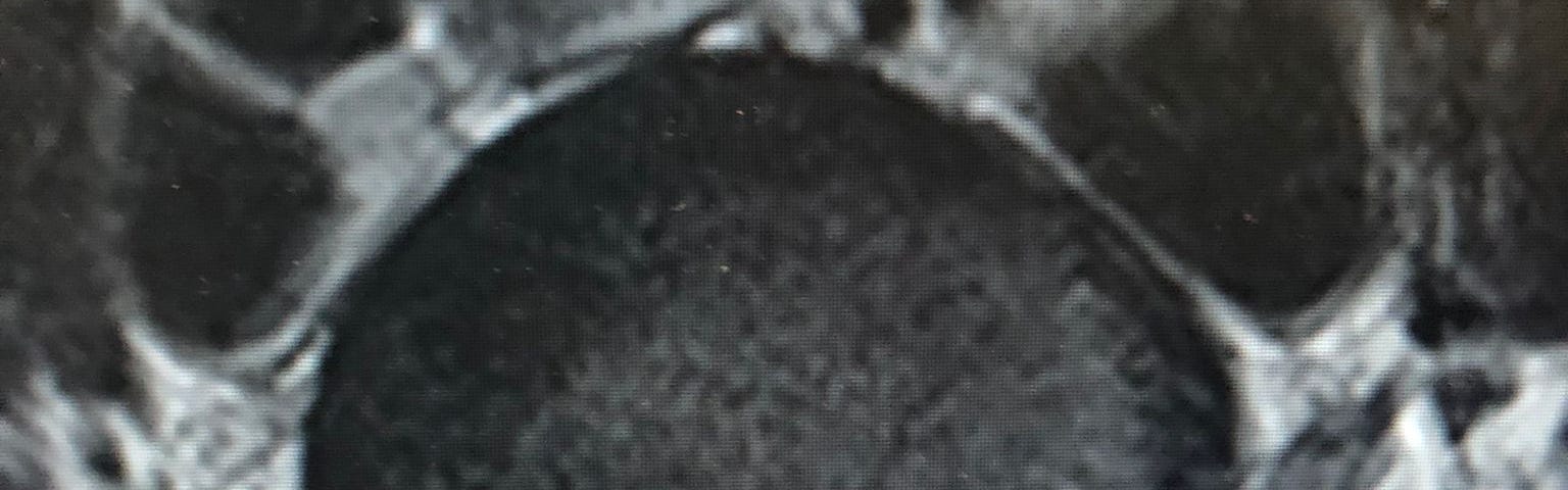 MRI scan of spine showing a spinal disc compressing a nerve root and abutting the spinal cord