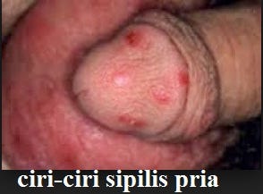 Ciri-ciri penyakit sipilis