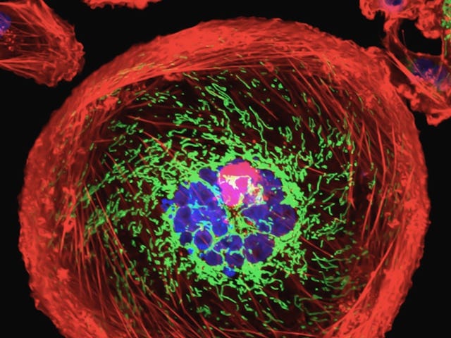 A luminous microscopic photo of breast cancer cell. A red outer circle with green, blue and pink images