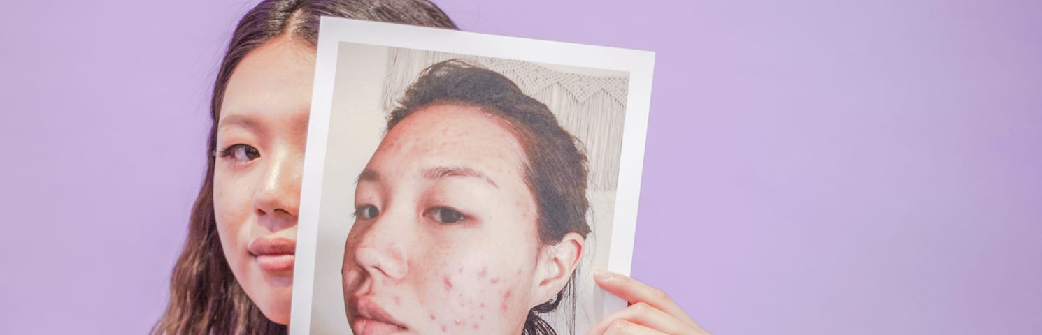 Curology user Hana Lee’s before and after skin transformation