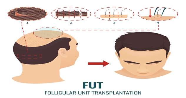 FUT Hair Transplant-Clinic Dermatech