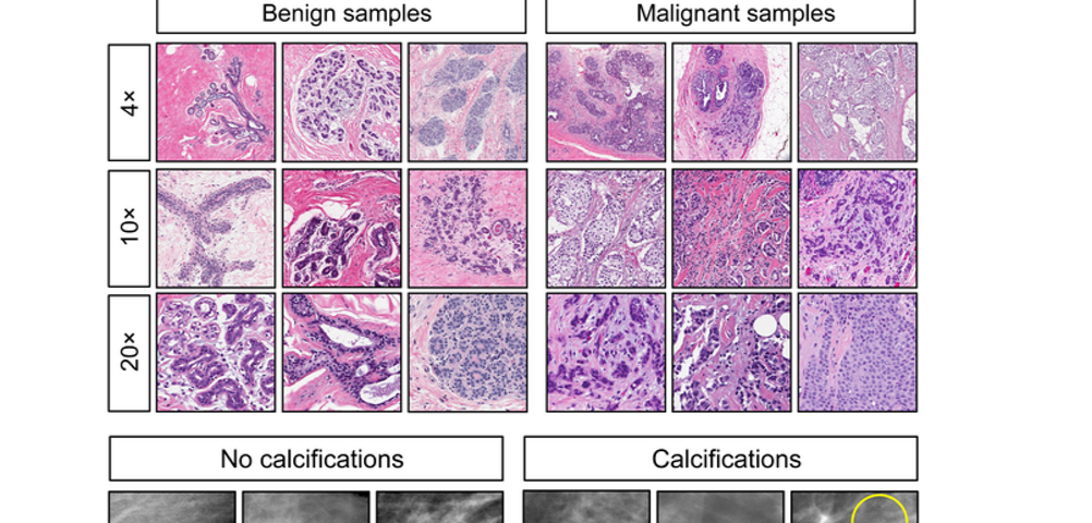 How To Do Reinforcement Learning in Real Life: Example datasets from the reinforcement learning experiment. Top Left: Benign samples; Top Right: Malignant samples; Bottom Left: No calcifications; Bottom Right: Calcifications.