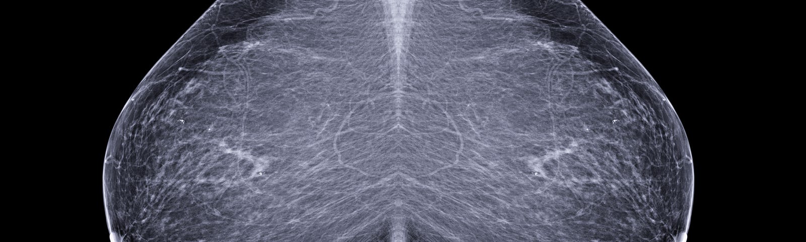 Mammograms of the left and right breast in black and white.