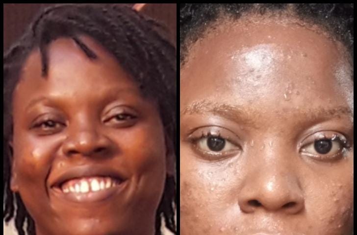 Two pictures placed side-by-side to show Blessing Oluchukwu Awamba before and during her menstrual cycle. To highlight the acne and pimples that show up during her monthly period.