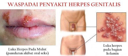 Obat Herpes Zoster. 