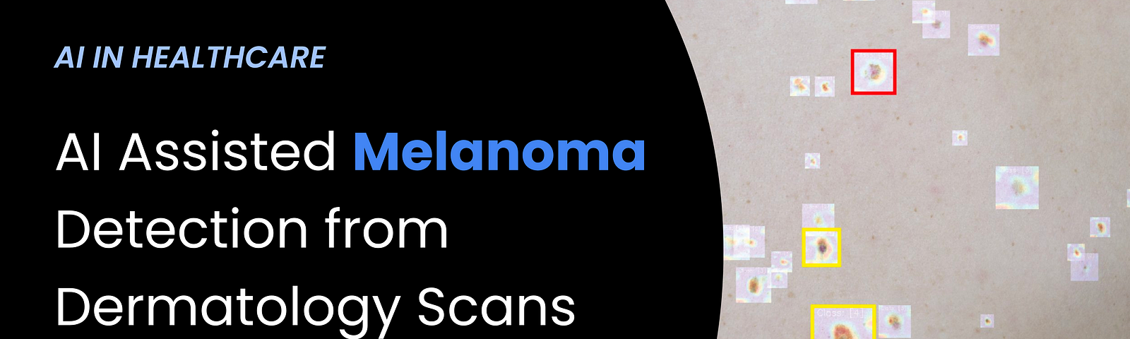 AI Revolutionizing Melanoma Detection from Dermatology Scans | Prodigal AI