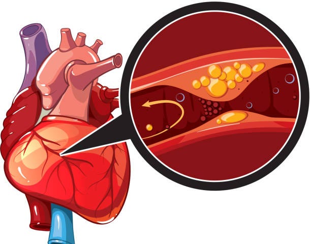 coronary artery disease