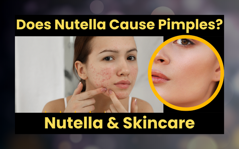 Does Nutella Cause Pimples