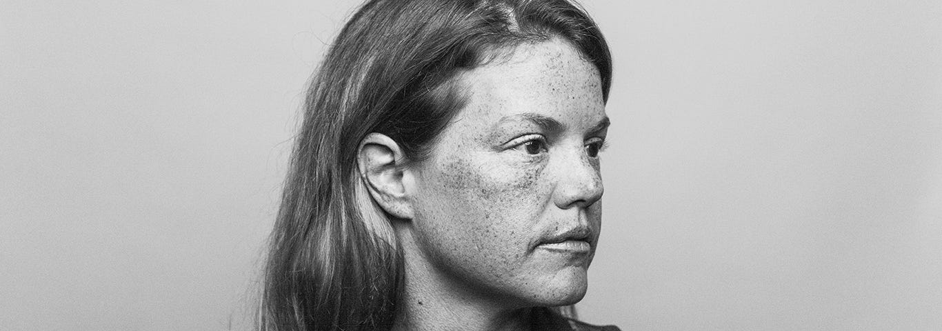 Woman with sun damage. One of the many photos that will convince you to wear sunscreen every day.