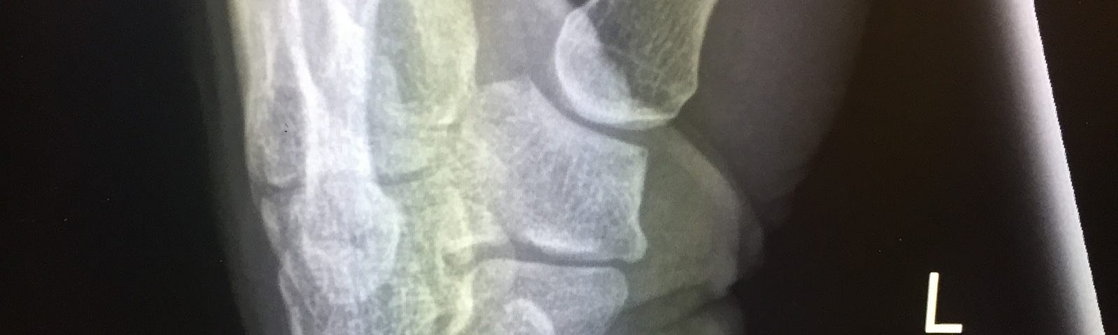 X-ray of a broken wrist