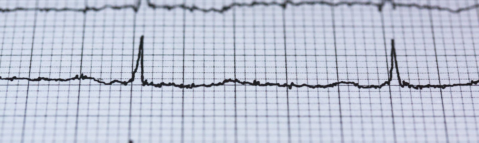 A picture of electrocardiogram, a graph of voltage vs time of the electrical activity of the heart with electrodes