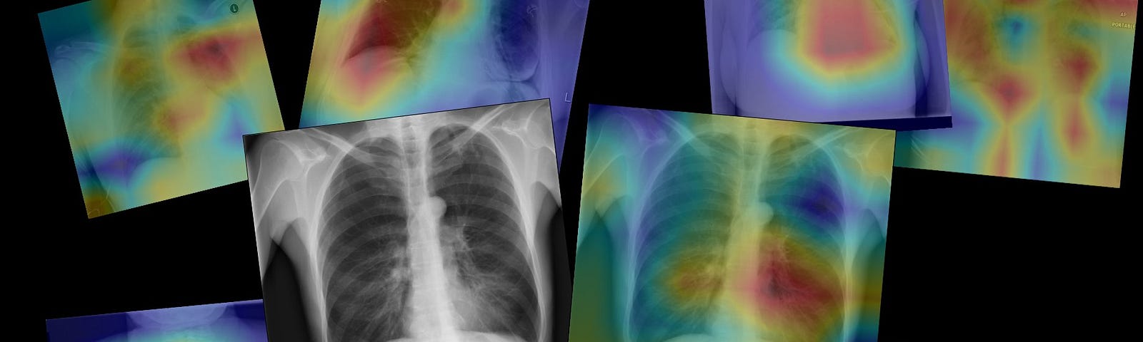 Different X-rays images with degrading color focus on a possible lesions in the thoraxic part