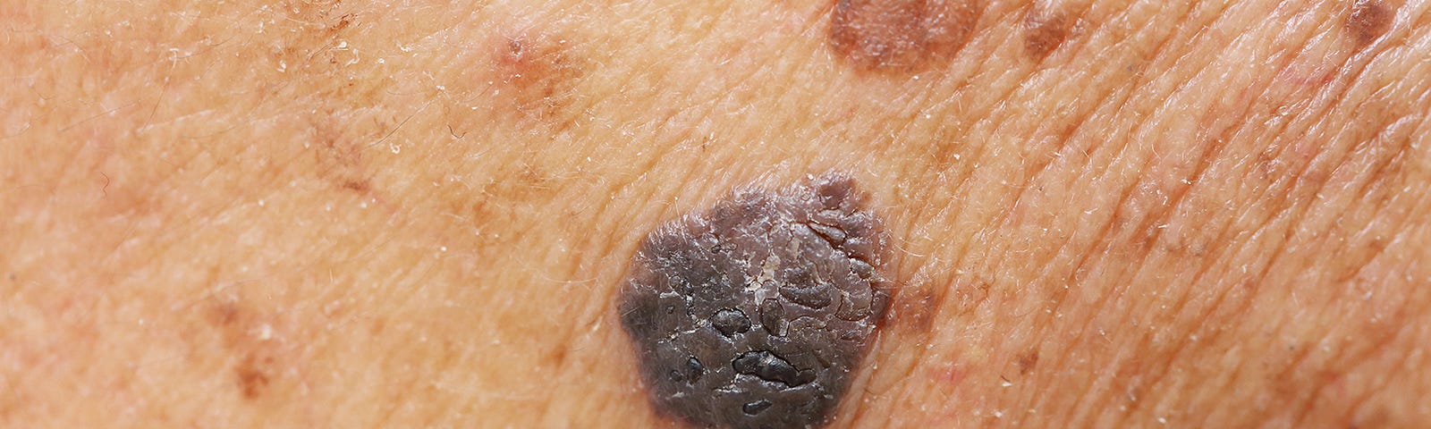 Moles, which are characterized as a small brownish spot, are a common growt...