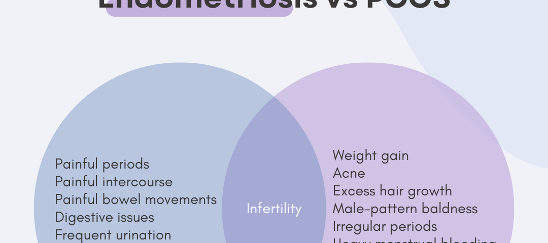 A Venn diagram illustrating the differences and similarities of symptoms for endometriosis and polycystic ovary syndrome.