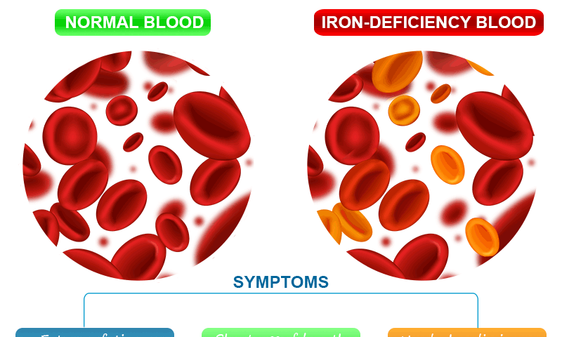 Iron Deficiency Anemia Symptoms, Causes, and Treatment