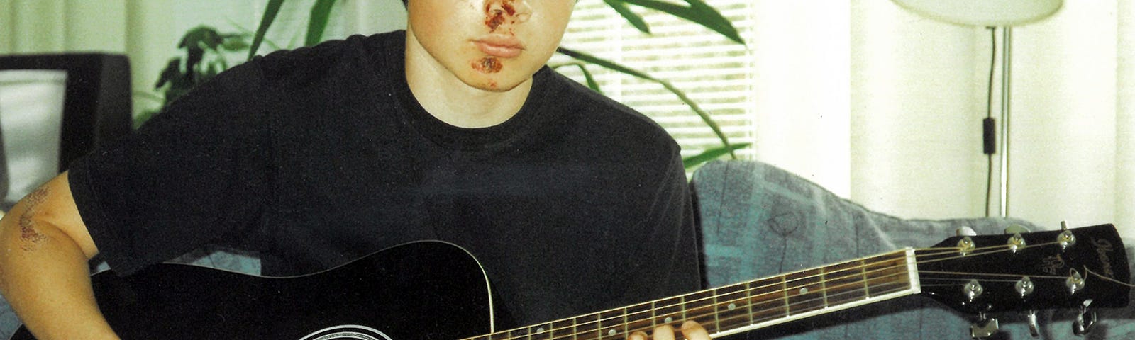 A young man sitting on a sofa with a guitar, left hand bandaged and fresh scars on his face.