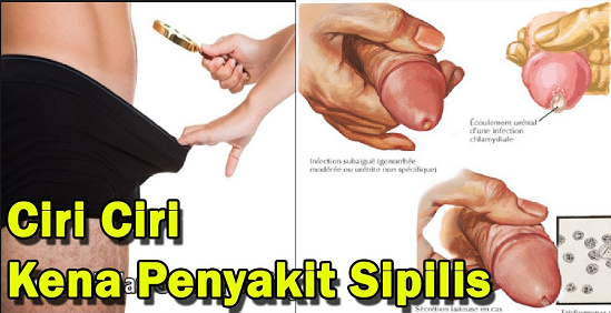 Contoh Sipilis : Sipilis Atau Raja Singa Pada Wanita Ucup ...